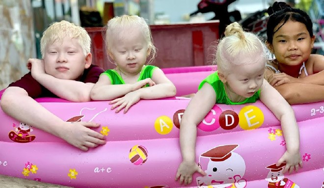 Cặp song sinh mắc bệnh hiếm ở Sóc Trăng, ba mẹ bị nói trục lợi, giờ ra sao? - Hình 3