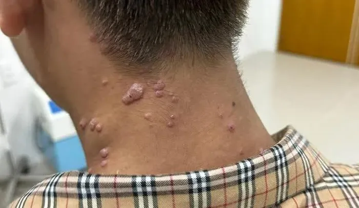 Thanh niên 17 tuổi ở Đồng Nai nghi mắc đậu mùa khỉ - Hình 1