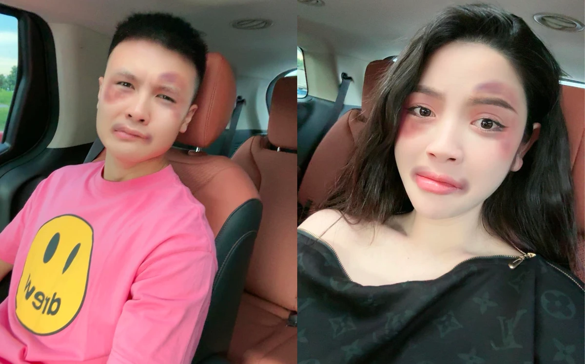 Vợ chồng Chu Thanh Huyền lộ mặt bầm tím sau khi lên tiếng vụ O Huyền sầu riêng - Hình 1