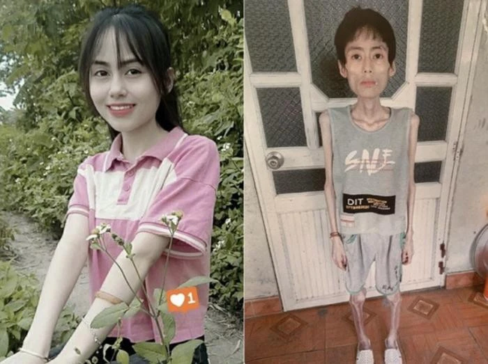 Cô gái Hưng Yên nhịn ăn giảm cân, từ xinh xắn đầy sức sống giờ còn da bọc xương - Hình 1