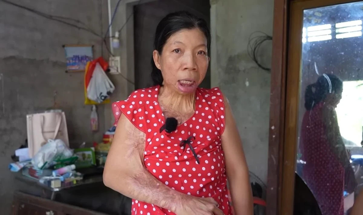 Người phụ nữ Vĩnh Long: 20 năm không cười, dị dạng sau bi kịch - Hình 1