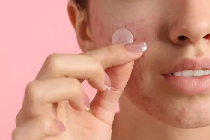 Điều ít biết về miếng dán mụn - Hình 1
