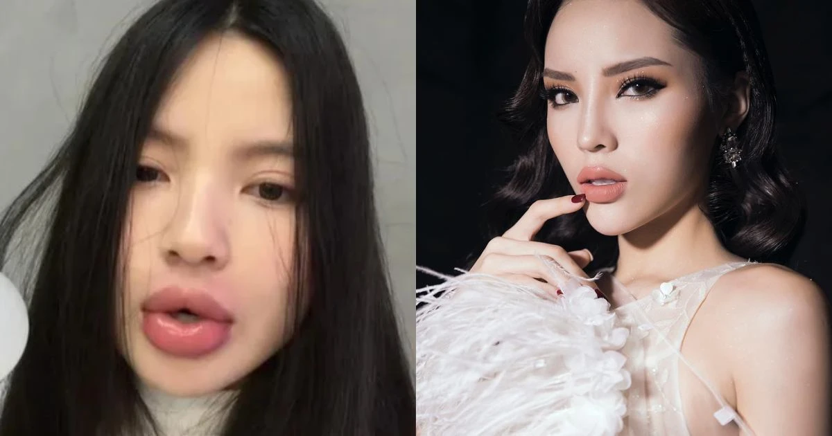 Kỳ Duyên - vợ Quang Hải cùng tiêm filler, kết quả hoàn toàn lại trái ngược - Hình 6