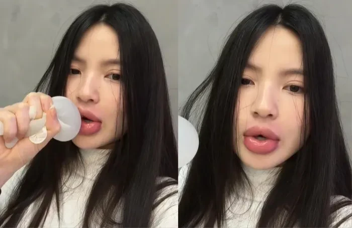 Kỳ Duyên - vợ Quang Hải cùng tiêm filler, kết quả hoàn toàn lại trái ngược - Hình 4