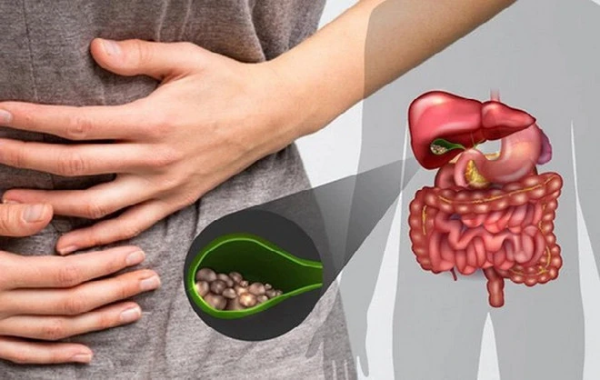 Giảm thiểu triệu chứng của bệnh sỏi túi mật: Nên ăn gì và kiêng gì? - Hình 2
