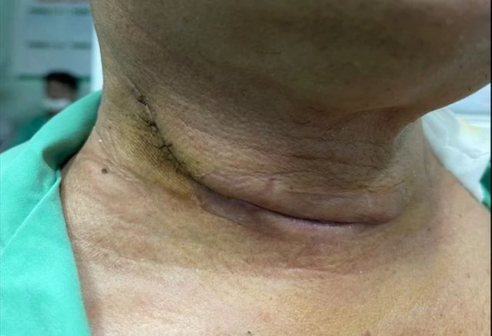 Phát hiện mắc cùng lúc 2 loại ung thư sau 6 tháng khàn tiếng - Hình 1