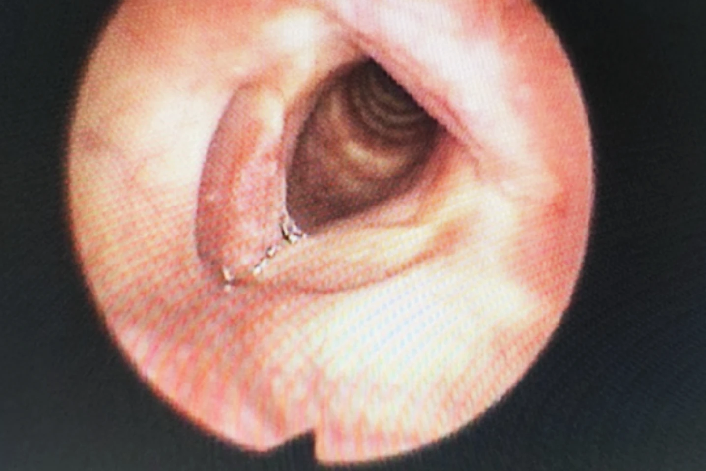 TPHCM: Phát hiện ca bệnh hiếm gặp, mắc cùng lúc 2 loại ung thư - Hình 1