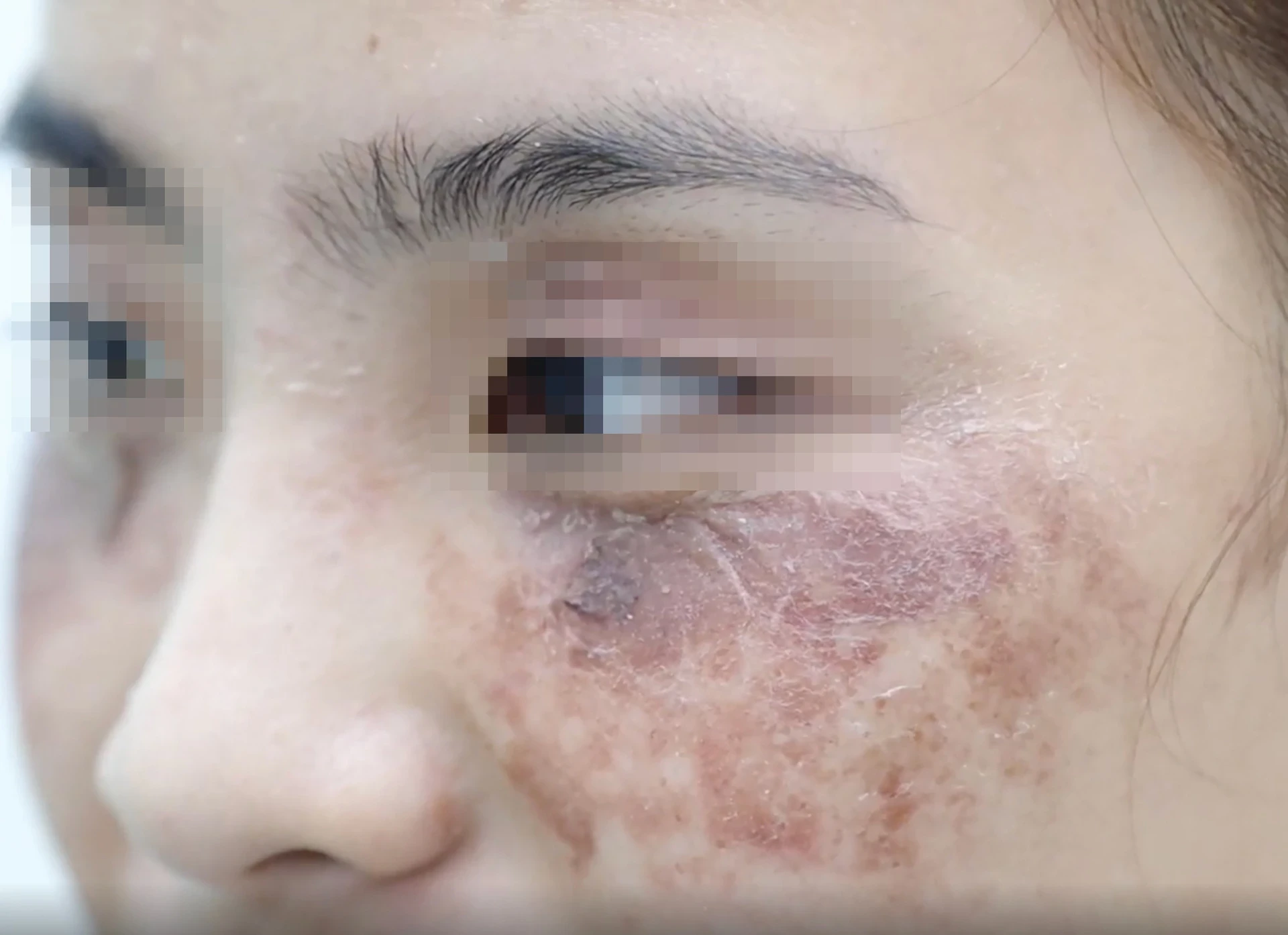 Mailisa vướng bê bối: Bác sĩ cảnh báo nguy cơ từ kem trị nám kém chất lượng - Hình 4