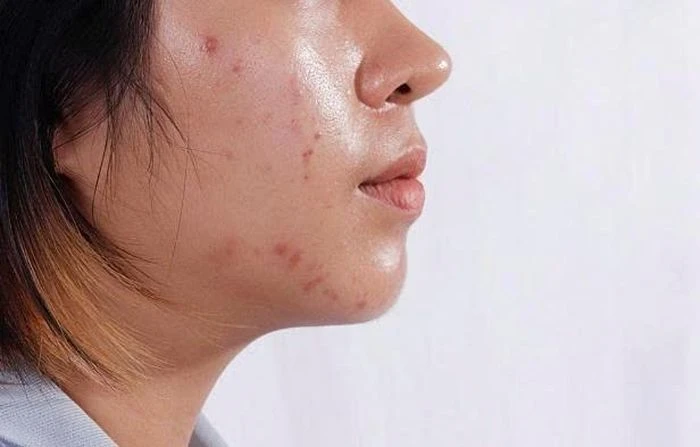 Bí quyết làm sạch dầu trên da mặt mà nhiều người bỏ qua - Hình 1