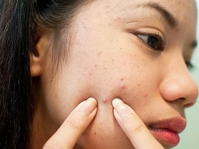 Giải pháp hạn chế tiết dầu cho da dầu vào mùa hè - Hình 2