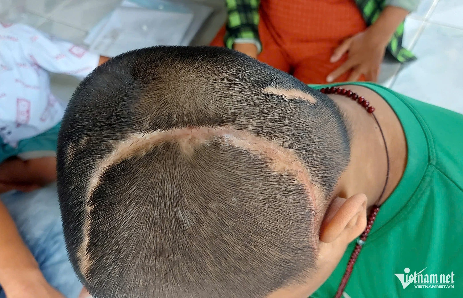 Vụ bé trai 7 lần mổ sọ: liệt nửa người bên phải, cha đèo con đến tòa làm 1 điều - Hình 3