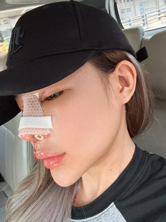 Ngân 98 nhập viện vì mũi viêm sau 11 lần sửa, sau 2 ngày quyết tháo băng đi diễn - Hình 2
