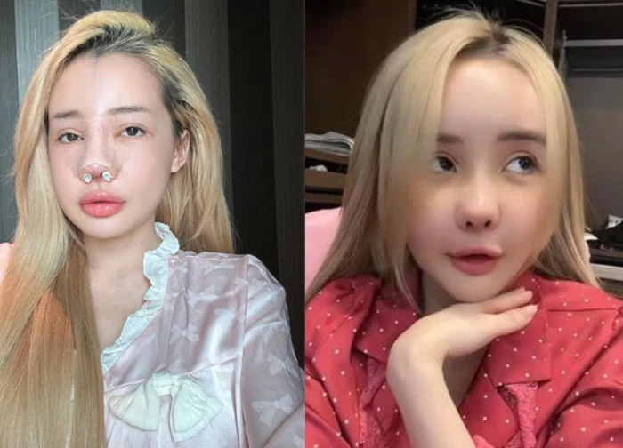 Ngân 98 nhập viện vì mũi viêm sau 11 lần sửa, sau 2 ngày quyết tháo băng đi diễn - Hình 1