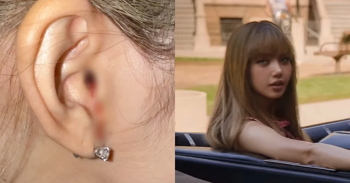 Lisa bị thương, chảy máu ở tai, Concert Blackpink có thể chỉ còn 3 người diễn? - Hình 8