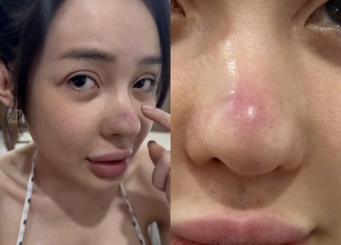 Ngân 98 suýt cắt mũi sau 11 lần dao kéo, còn thản nhiên ăn đồ độc, CĐM la ó? - Hình 1