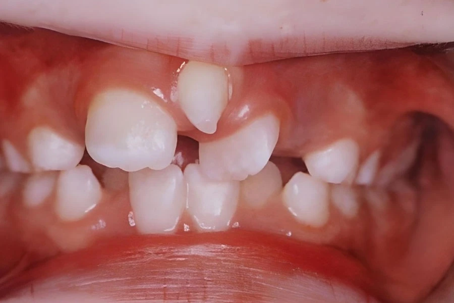 Hy hữu cô bé có đến 81 chiếc răng, vượt giới hạn bình thường, bác sĩ bó tay? - Hình 3