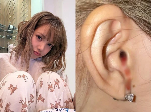 Lisa phát ngôn sốc về vụ tai chảy máu lộ tình trạng đáng lo, không thể comeback? - Hình 1