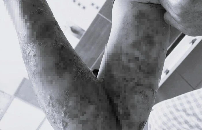 Tự trị bệnh tại nhà, người đàn ông nhập viện vì nhiễm trùng nặng - Hình 1