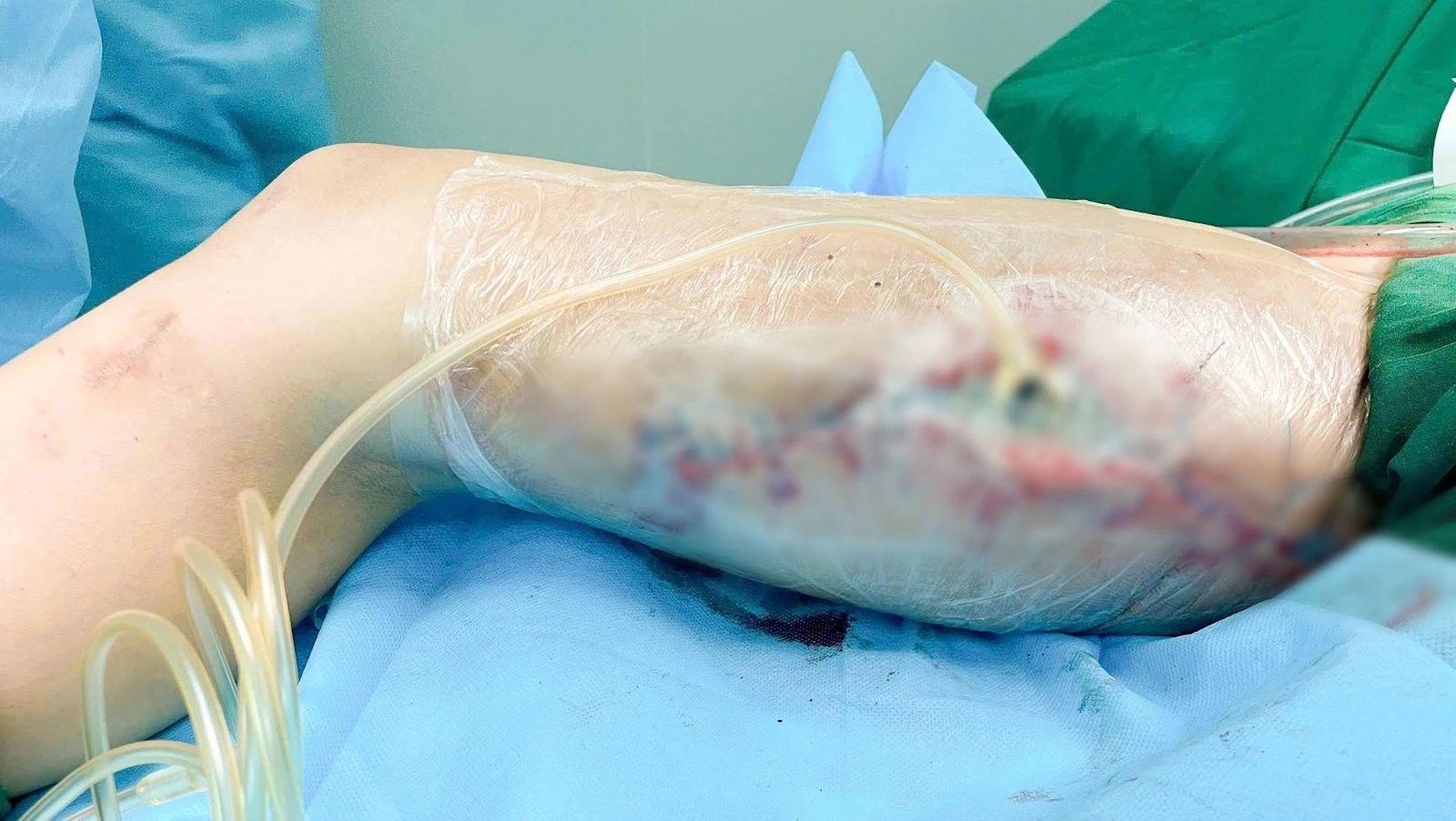 Tiêm filler toàn thân: cô gái kêu gào, lộ bó cơ, bác sĩ vào cuộc mổ nghẹt thở - Hình 2