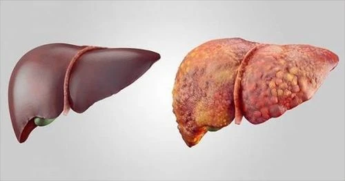 Căn bệnh khiến diễn viên Bắc Hải qua đời nguy hiểm ra sao? Đàn ông càng dễ mắc - Hình 4