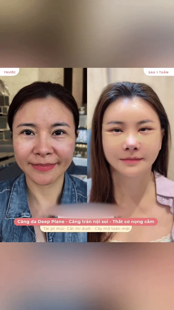 Diễn viên Vbiz đập mặt xây lại ở Hàn: Mặt băng bó chằng chịt, 2 đêm đầu khó chịu không thể thở - Hình 3