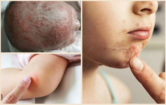 Viêm nang lông ở trẻ có nguy hiểm không? - Hình 1