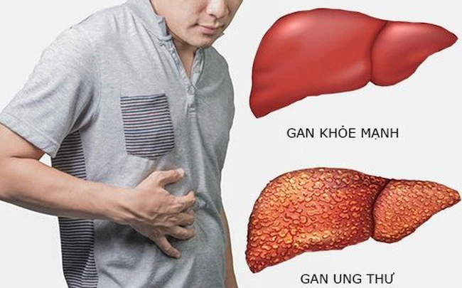 Bí quyết giúp giảm nguy cơ ung thư gan - Hình 1
