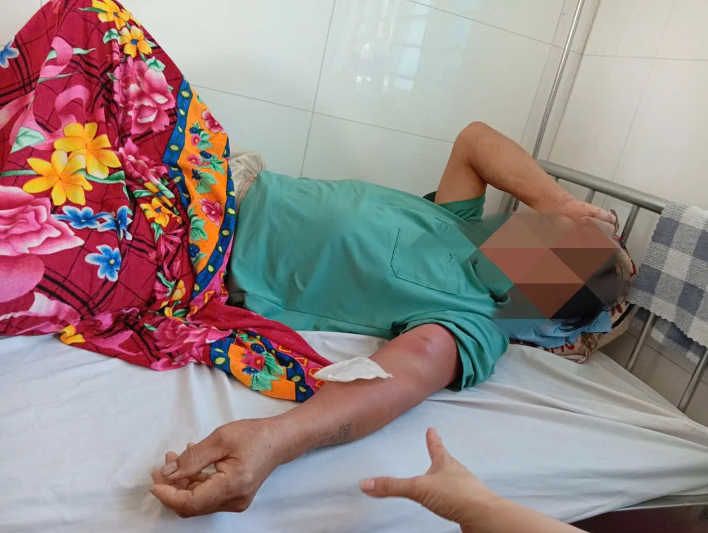 Giun rồng chui dưới da sau nhiều ngày đi rừng uống nước suối - Hình 1