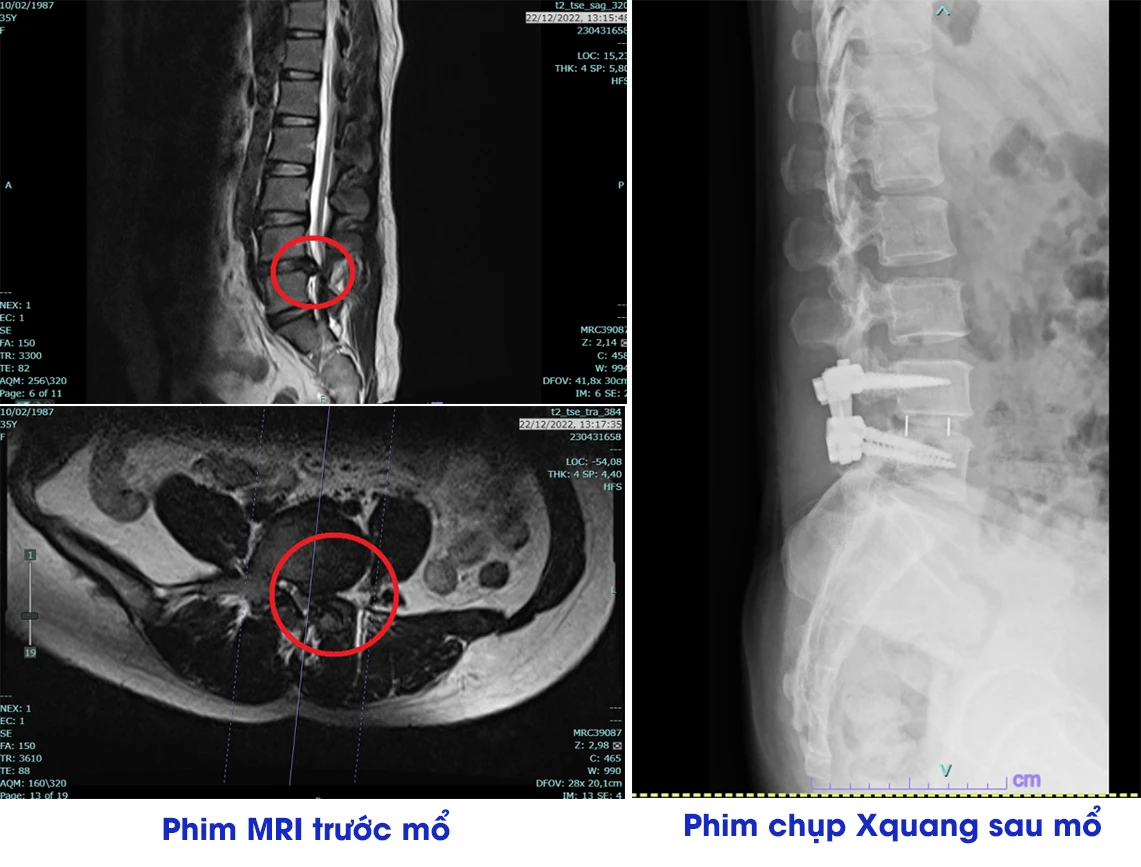 Thoát vị đĩa đệm khi nào cần phẫu thuật? - Hình 2