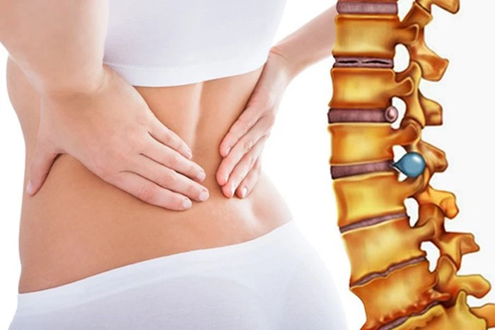 Thoát vị đĩa đệm khi nào cần phẫu thuật? - Hình 1