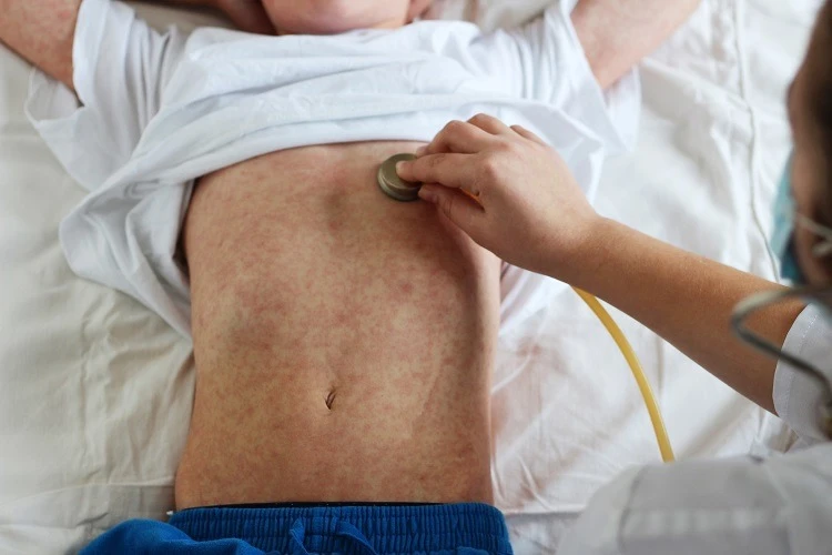 Sắp Tết, cảnh giác với bệnh sởi bùng phát ở trẻ em - Hình 1