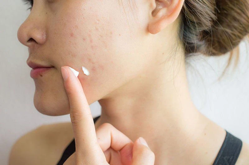 6 sai lầm khi chữa mụn trứng cá - Hình 1