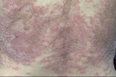Cảnh giác với căn bệnh không lây nhưng nguy hiểm - Hình 1