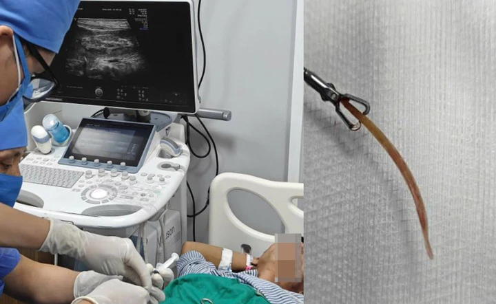 Đau bụng suốt 10 ngày, bất ngờ phát hiện tăm tre đâm thủng đại tràng - Hình 1