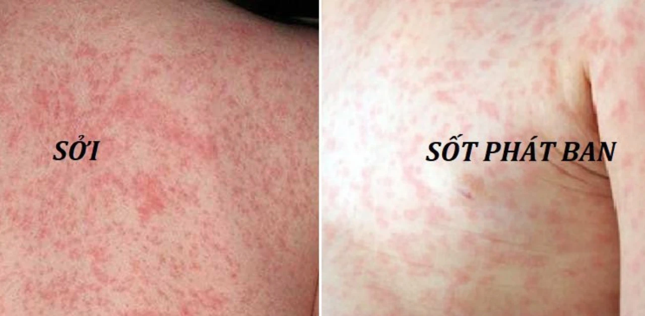 Dấu hiệu nhận biết sớm 5 bệnh truyền nhiễm thường gặp trong mùa mưa - Hình 1