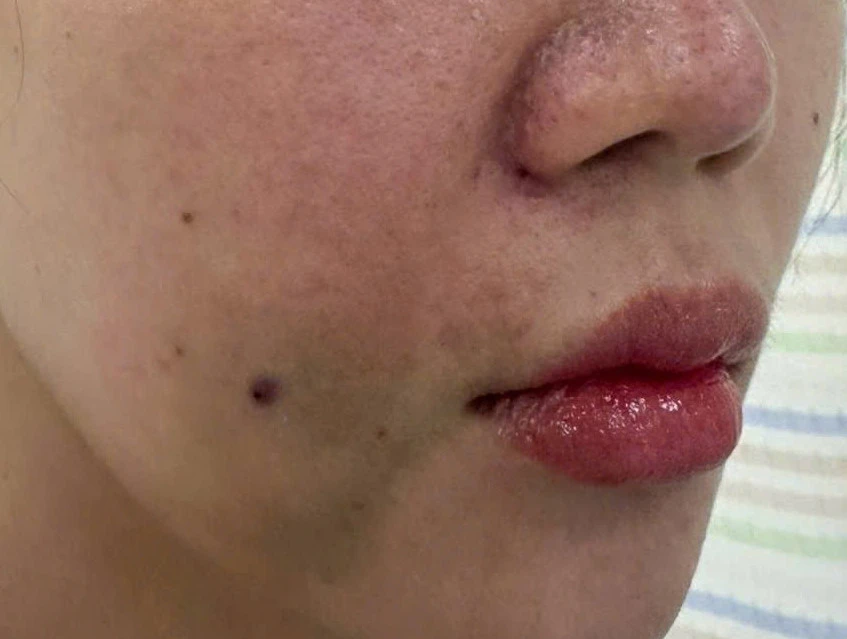 Cô gái bị tắc mạch, hoại tử sau khi tiêm filler làm đầy rãnh cười ở spa - Hình 2