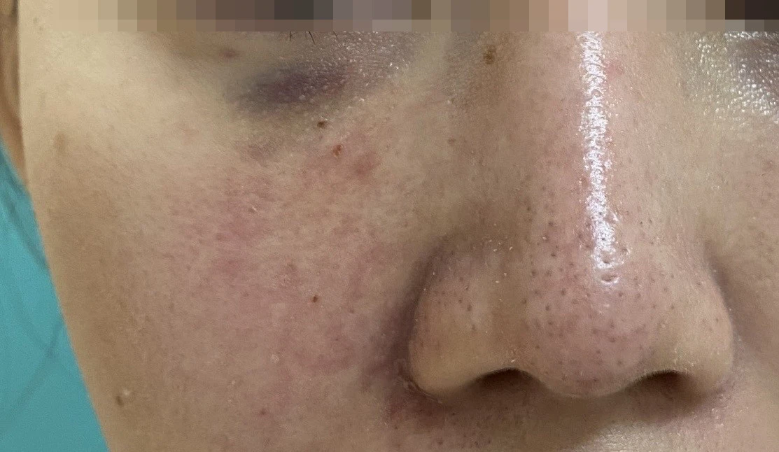 Cô gái bị tắc mạch, hoại tử sau khi tiêm filler làm đầy rãnh cười ở spa - Hình 1