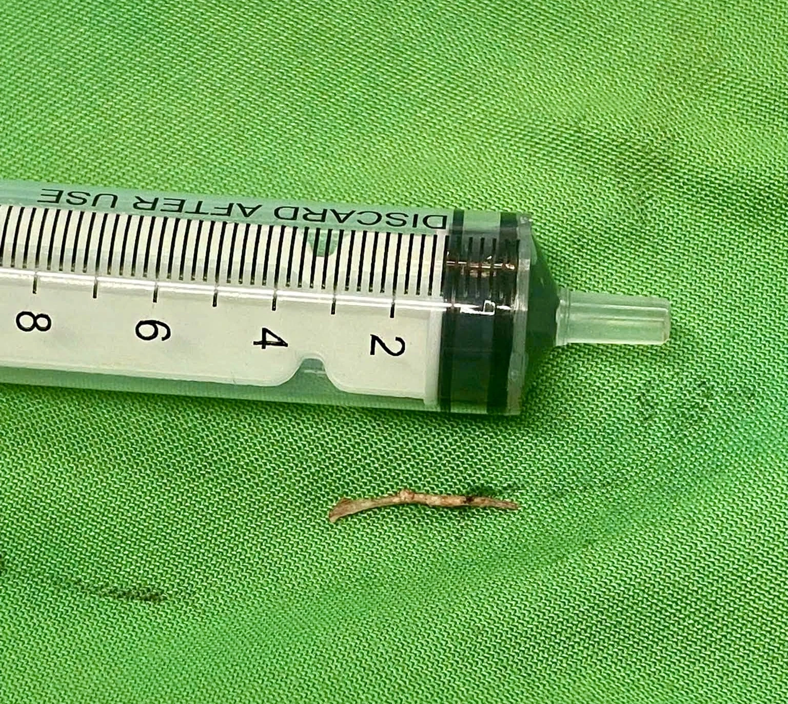 Mắc xương cá, người đàn ông phải cắt bỏ tuyến dưới hàm - Hình 2