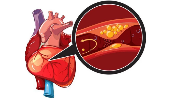 Đau ngực khi đá bóng, người đàn ông 32 tuổi phát hiện nhồi máu cơ tim - Hình 1