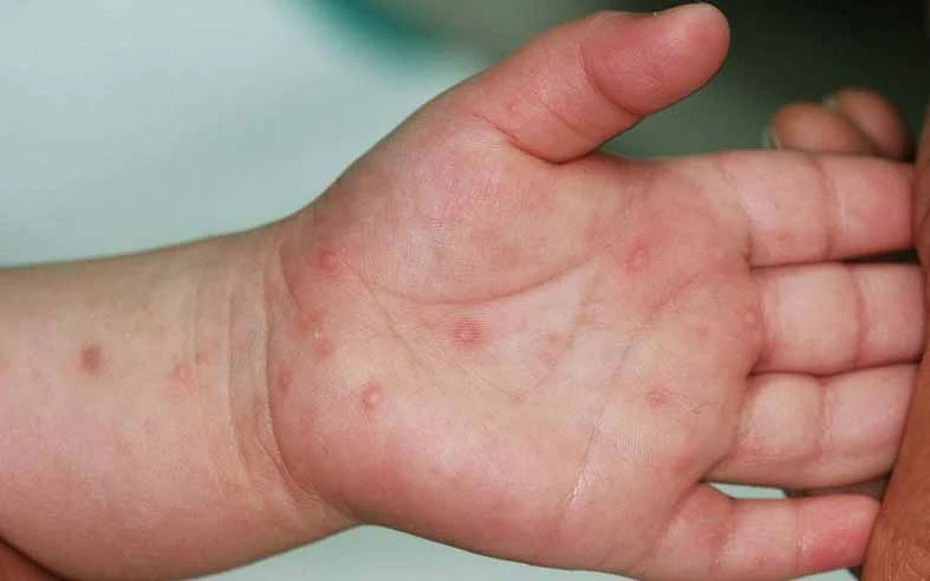 Tp.HCM ghi nhận số ca tay chân miệng tăng 47% trong một tuần - Hình 1